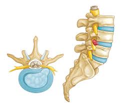 Disc herniation symptoms usually start for no apparent reason. Herniated Disk In The Lower Back Orthoinfo Aaos
