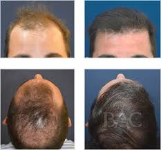Trapianto di capelli senza rasatura. Trapianto Di Capelli Bac Di Villa Stuart E Tricopigmentazione Il Meglio Dell Innovazione