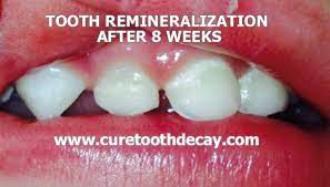 Photographic Proof Of Remineralized Cavities Healthy Home Economist Heal Cavities Tooth Decay Remedies Cure Tooth Decay