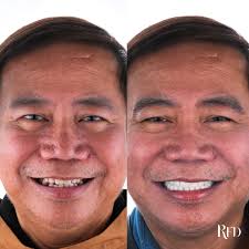 Dr.Ralph Figaroa Delas Alas 🇯🇵🇰🇷🇲🇾🇮🇩🇹🇭🇨🇳🇸🇬🇦🇪🇫🇷🇩🇪  (@dr.rfdsmile) • Instagram photos and videos