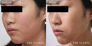 小顔 二重顎の解消の症例写真 脂肪吸引 痩身ならthe clinic 脂肪吸引 美容整形 症例