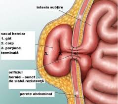 Dar corect ar trebuie să spună „mă doare în dreapta, sub coaste. Durere Abdomen Sub Stern Hernie Move Flex Gel In Romania