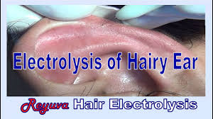 Electrolysis is a permanent hair removal method that targets each individual hair follicle, making it ideal for small and sensitive areas such as the face, ears, penis, scrotum and around the anus. Electrolysis Of Ear Hair Youtube