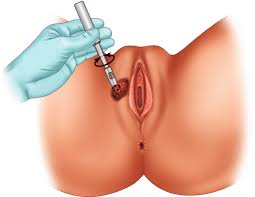 Wide Local Excision Of The Vulva, With Primary Closure Or Z-Plasty Flap