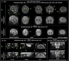 Development of neonatal-specific sequences for portable ultralow field  magnetic resonance brain imaging: a prospective, single-centre, cohort  study - eClinicalMedicine