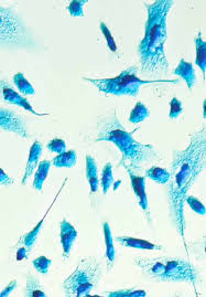 Prostate cancer is one of the most common types of cancer that develops in men and is the second leading cause of cancer deaths in american men, behind lung cancer and just ahead of colorectal cancer.the prognosis for prostate cancer, as with any cancer, depends on how advanced the cancer has become, according to established stage designations. Rehabilitation Of Patients With Prostate Cancer Intechopen