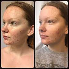 B A One Week On Differin Gel Differin Gel Skin Gel