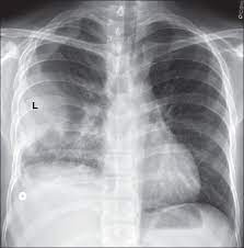 Loculated effusions occur most commonly in association with conditions that cause intense pleural inflammation, such as empyema, hemothorax, or tuberculosis. View Image