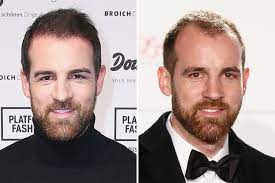 Check spelling or type a new query. Er Hat Die Haare Schon Haartransplantation Haare Haarausfall Frauen