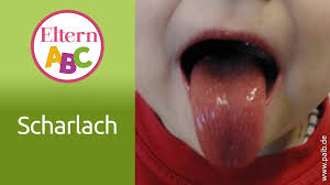 Scharlach Bei Kindern Symptome Ansteckung Therapie Eltern De