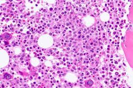 It breaks down a fatty. Experimental Treatment For Niemann Pick Disease Appears Safe