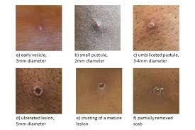 Scientific studies are now underway to assess the feasibility and appropriateness of using vaccinia vaccine for the prevention and control of monkeypox. Monkeypox Gov Uk