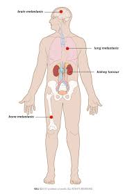 What type of cell makes up the tumor? Kidney Cancer Patient Information