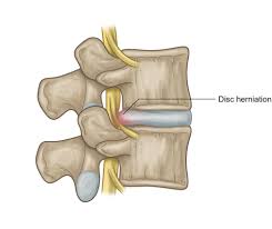 Watch the video explanation about how to sleep with a herniated disk. Lumbar Disc Herniation Yoga My Personal Journey Stacy Dockins