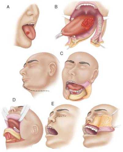 Oral cavity cancer clinical image