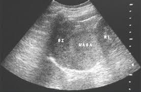 Sonda de ultrasonido acuson c3. Ultrasonido Abdominal Que Muestra Masa En Posicion Suprarrenal Y Sus Download Scientific Diagram
