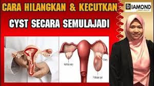 Cara rawat buasir yang perlu anda ketahui. Ubat Penawar Rawatan Alternatif Kecutkan Cyst Secara Semulajadi Tanpa Pembedahan Pengedar Shaklee Stokis Shaklee Vivix Shaklee