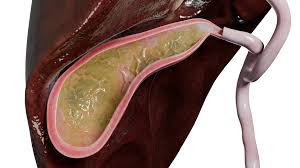Cholecystitis: Types, Causes, Symptoms, Diagnosis, and Treatment