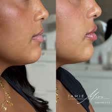 Schedule your appointment with Jamie Mora, PA-C @Studiophilly Link in my  bio 267-586-4978 Hablo Español 🇨🇴 Treatments/Pricing -SKINVIVE