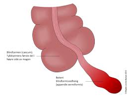 Siden det er trangt i. Blindtarmbetennelse Nhi No