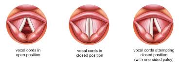 Image result for Vocal Cord Dysfunction