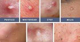 Fungal acne adalah benjolan kecil berisi. Fungal Acne Talk About Skincare