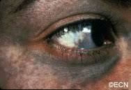 Image result for nevus sclerae