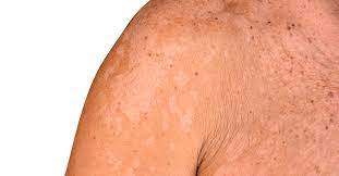 كيفية علاج التينيا الملونة ويب طب