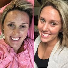 5 months to a new face with Pomifera products