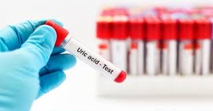Bicarbonatul de sodiu bicarbonatul de sodiu poate ajuta la reducerea durerilor provocate de un nivel crescut de acid uric, insa are si capacitatea. Acid Uric Ce Inseamna Un Nivel Crescut Sau Scazut Alimente Interzise