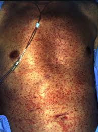 Cephalexin may cause diarrhea, and in some cases it can be severe. Drug Rash And Eruption Symptoms Pictures Causes And Treatment