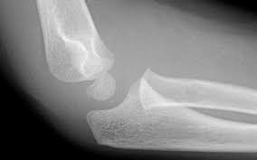 Image result for Lateral Condyle Fracture