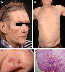 The early symptoms of lung cancer may be a slight cough or shortness of breath, depending on which part of the lung is affected. Regression Of Paraneoplastic Rash After Lung Cancer Chemotherapy Journal Of Thoracic Oncology