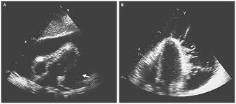 Image result for Pericarditis