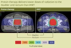 Imrt Conventional Radio Therapy V S Proton Therapy Highlighted In Blue Is The Exposure Of Healthy Organs 30 The Red Is W Protons Bladder Childrens Hospital