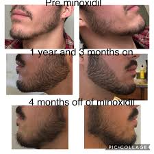 Maybe you would like to learn more about one of these? Minoxidil Beard Before And After