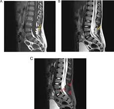 Image result for Dysraphism