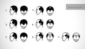 Hair Loss In Men Ilter Clinic