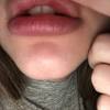 It is one of the newest techniques for plumping lips and adding lumps and bumps are totally normal with hyaluron pen fillers. 1