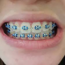Dental Assistant Jobs Near Me 2020 Dental Braces Braces Teeth Colors Teeth Braces
