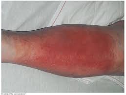 Image result for erysipel photos)