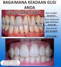 Gusi bengkak di bahagian belakang bawah kanan. Gusi Anda Berdarah Klinik Pergigian Angkasa Sri Rampai Facebook