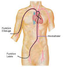 Linksherzkatheter Coronarangiographie Aufgrund Von Entsprechenden Beschwerden Und Oder Bereits Vorliegender Befunde Kann Die Durchfuhrung Einer Linksherzkatheter Untersuchung Koronarangiographie Erforderlich Werden Die