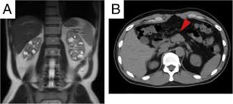 The symptoms can differ based on how bad the kidney failure is, how quickly it is getting worse, and what is causing it. Autosomal Dominant Tubulointerstitial Kidney Disease Hnf1b With Maturity Onset Diabetes Of The Young A Case Report With Kidney Biopsy Kidney Medicine