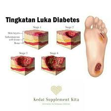Hari ini mama akan kongsikan tanda awal penyakit ini yang perlu kita perhatikan. Luka Diabetes Luka Yang Boleh Di Rawat Kedai Supplement Kita
