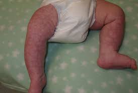 As long as there are no unusual aspects, for example enlarged birthmarks, they are generally harmless. Cutis Marmorata Consultant360