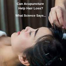 Like chinese herbs, the objective of acupuncture for baldness is to correct imbalances or disharmonies that. Ees Can Acupuncture Help Hair Loss
