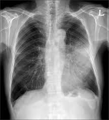 Chest X Ray Showed The Ill Defined Patchy Mass Opacity With Surrounding Download Scientific Diagram