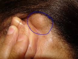 For example, lumps that form in the armpit are. Lumps Behind Ear Nodule Behind Ear Causes Symptoms Treatment Healthmd