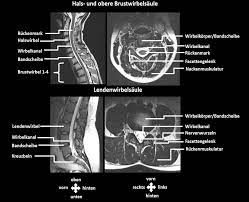 Neurochirurgie Northeim Wirbelsaulenerkrankungen